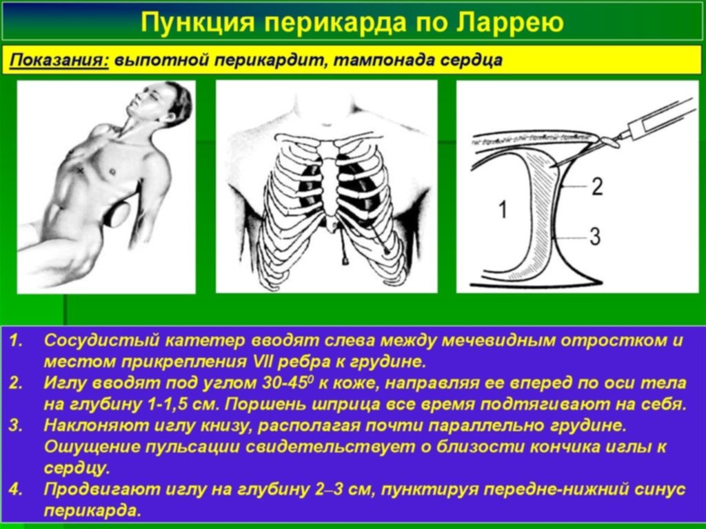 Операции на грудной стенке