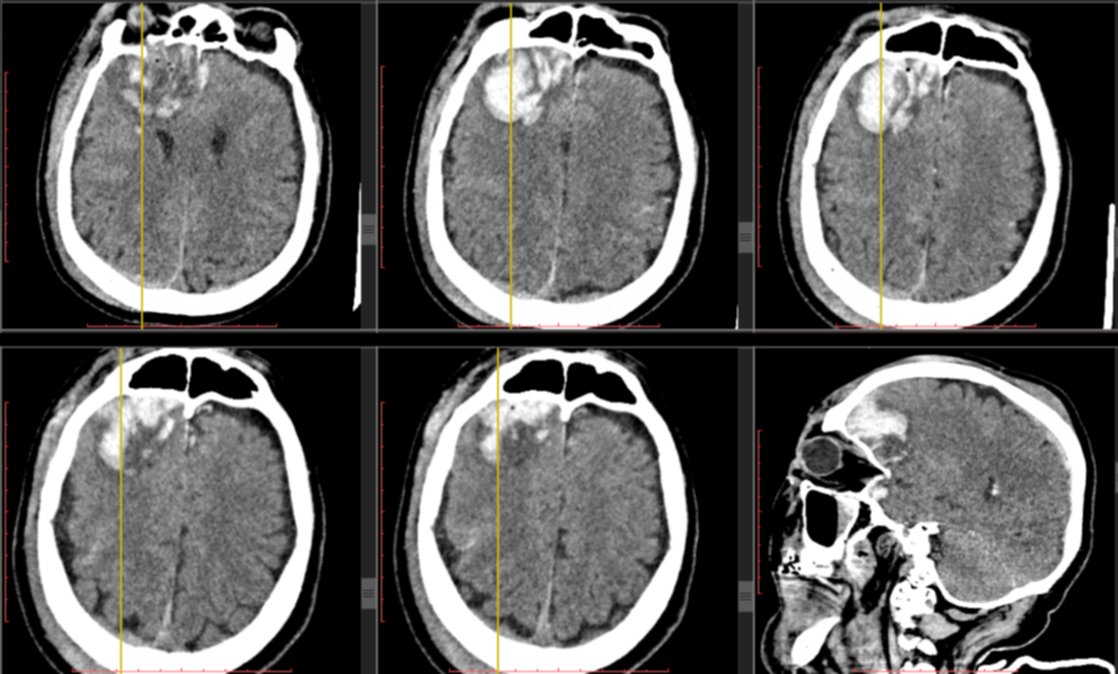 Гематома головного мозга. Внутримозговая гематома кт. Гематома головного мозга кт. Гематома лобной доли кт.