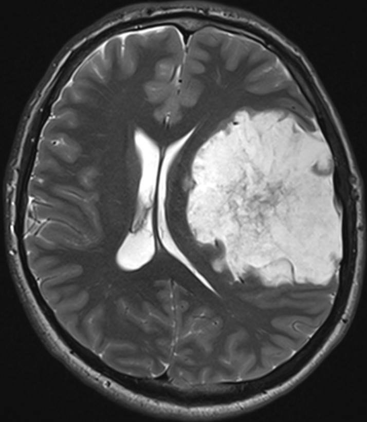 Перл 2023 рак. Глиома головного мозга мрт. Глиома головного мозга кт. Опухоль головного мозга левой височной доли мрт. Опухоль теменной доли головного мозга.