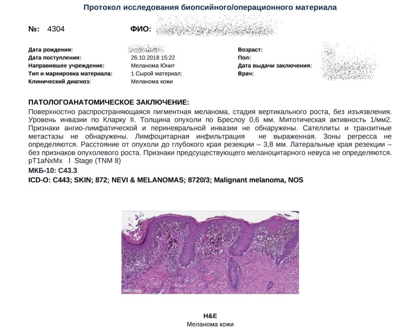 Уровни инвазии меланомы. Меланома гистология заключение. Меланома кожи гистологическое заключение. Поверхностно распространяющаяся меланома гистология. Меланома кожи гистология описание.