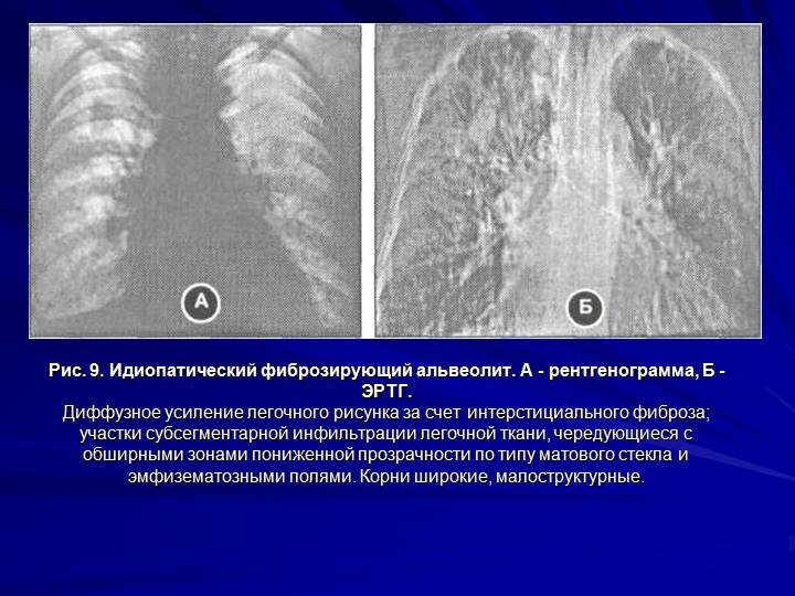 Какая рентгенологическая картина характерна для легочного фиброза