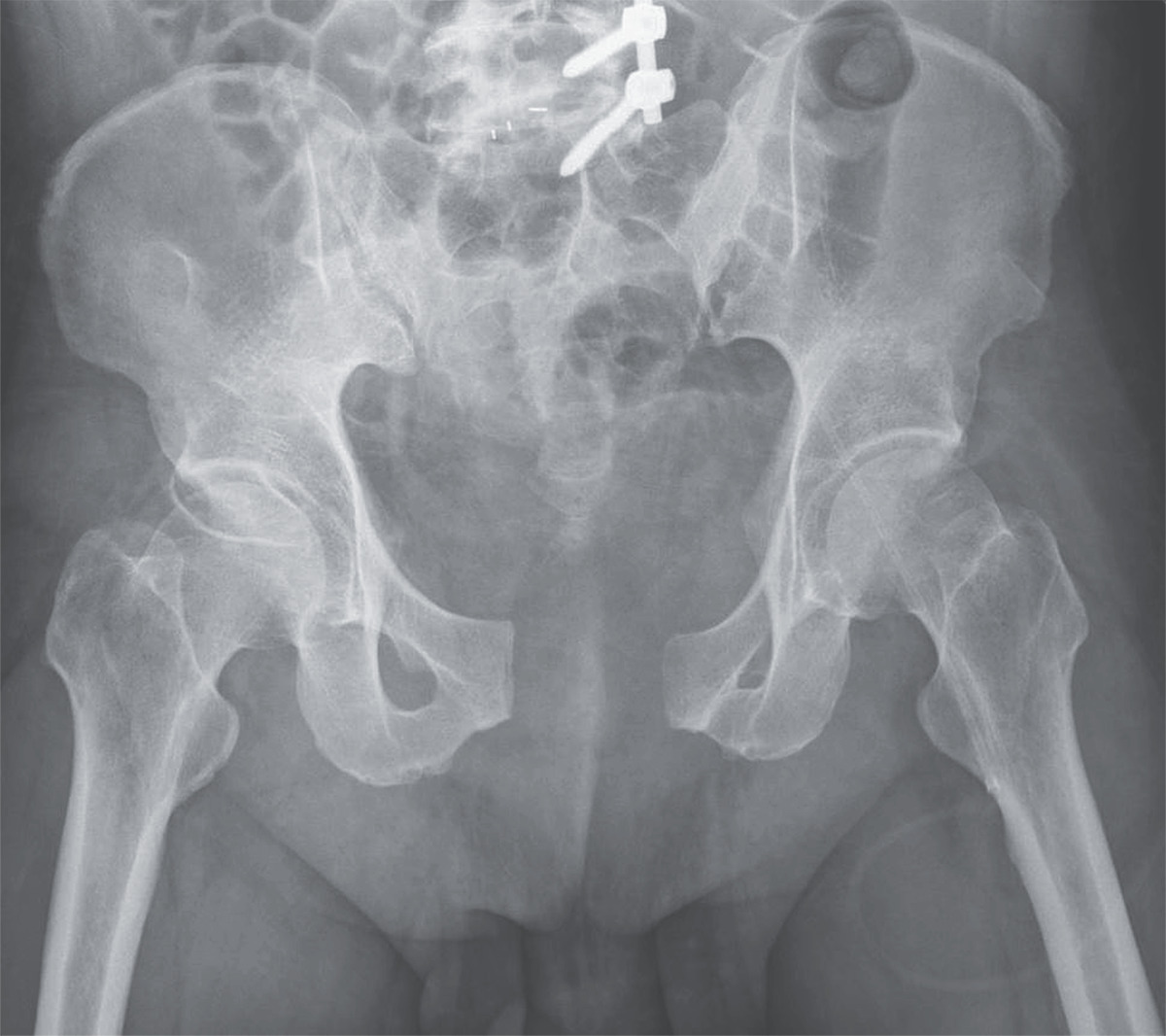 Перелом костей таза рентгенограмма