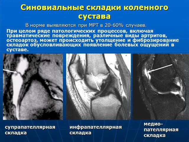 Где можно сделать мрт коленного сустава. Сумки коленного сустава анатомия мрт. Сумки коленного сустава мрт. Мрт коленного сустава картинки. Супрапателлярная складка коленного сустава мрт.