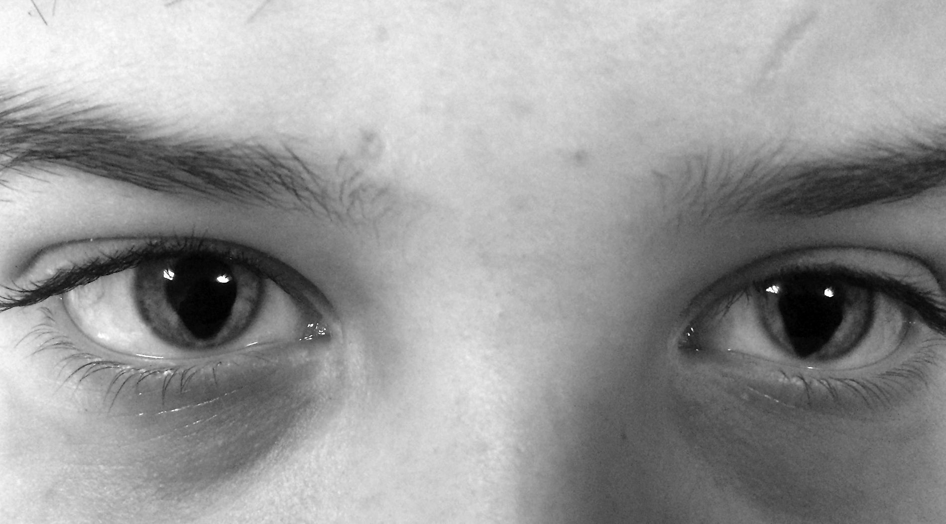 Глаза признак. Колобома радужной оболочки. Синдром Шмида-Фраккаро синдром кошачьего глаза. Колобома зрачок кошачий глаз.