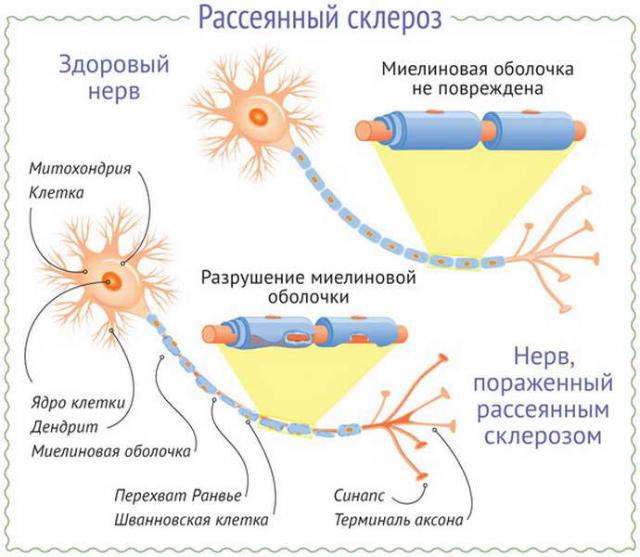 Рассеянный склероз: симптомы, признаки, типы, стадии и …