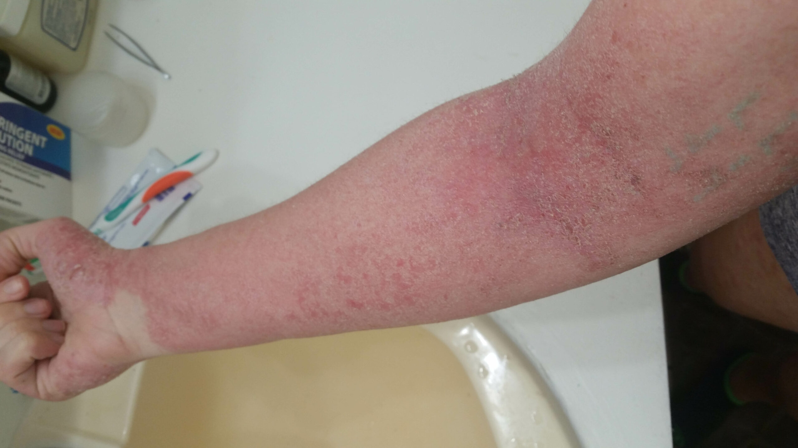 Синдром отмены ТКС