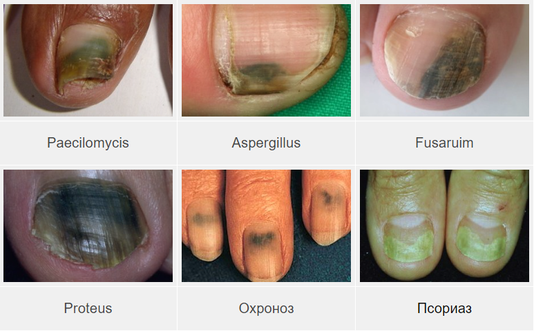    green nail syndrome -  