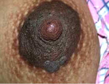 Shishgan areolalarning fotosurati