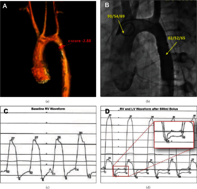 Рестриктивная кардиомиопатия у 11-летней девочки | Статьи | МирВрача