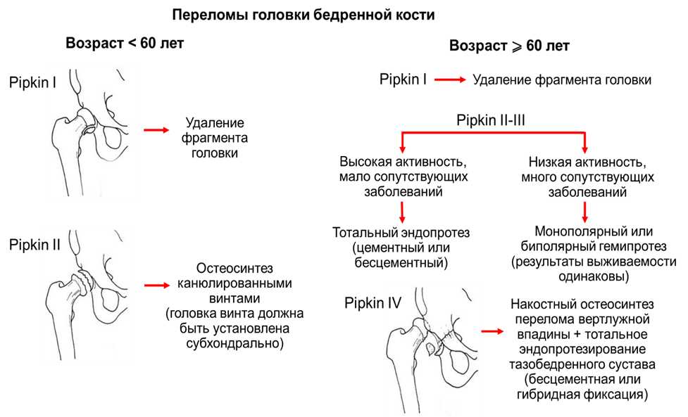 Перелом головки бедренной кости мкб. Классификация переломов головки бедренной кости Pipkin. Перелом проксимального отдела бедренной кости. Задержка развития головок бедренных костей.