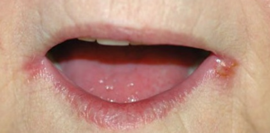 Заеда - ангулярный хейлит