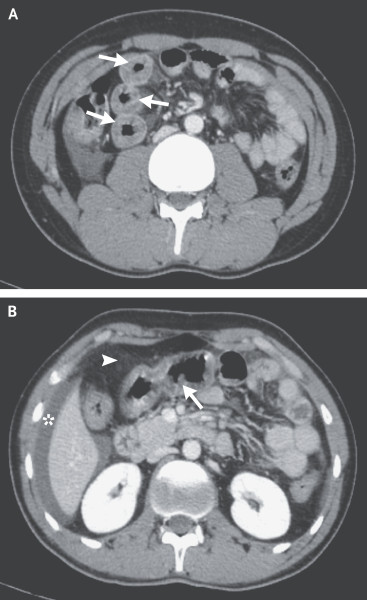 Наследственный ангионевротический отек