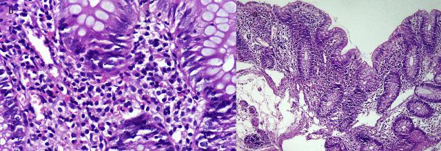 Эозинофильный колит